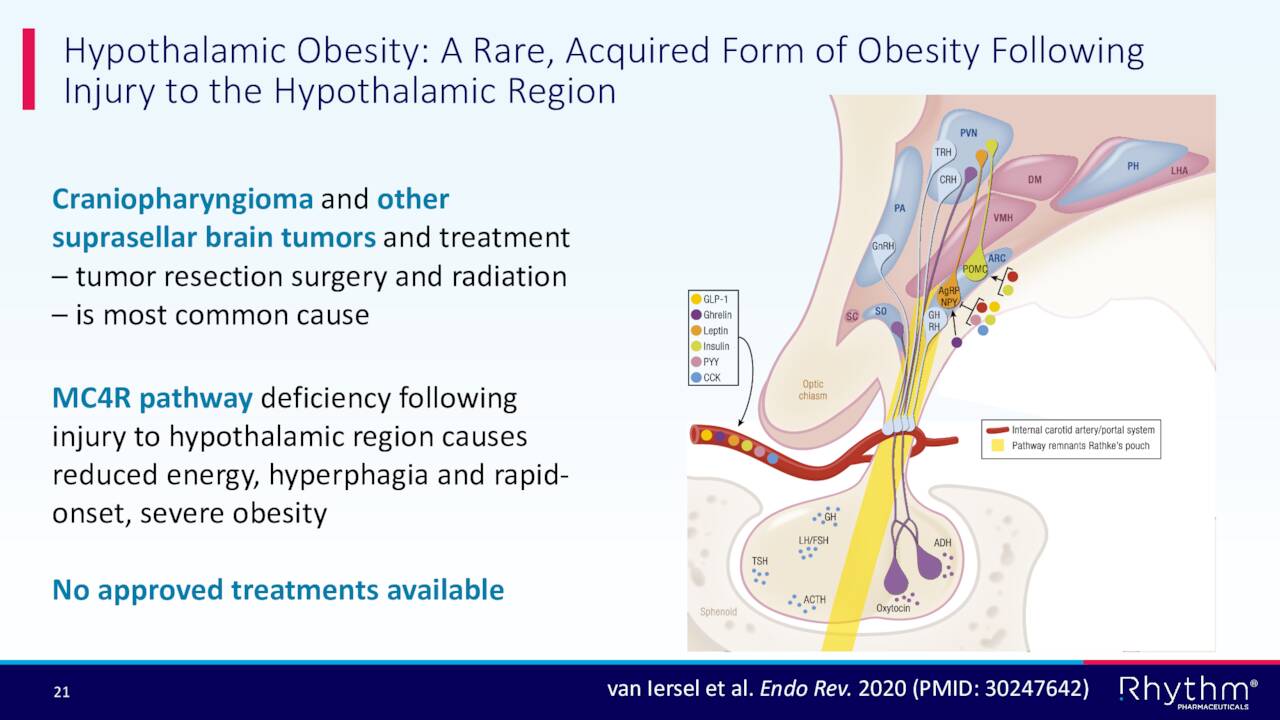 Hypothalamic Obesity: A Rare, Acquired Form of Obesity Following