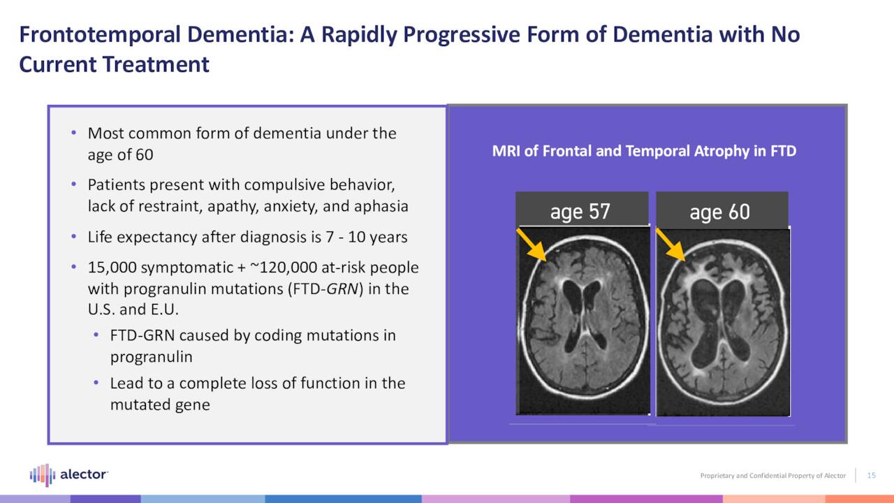 Frontotemporal Dementia: A Rapidly Progressive Form of Dementia with No