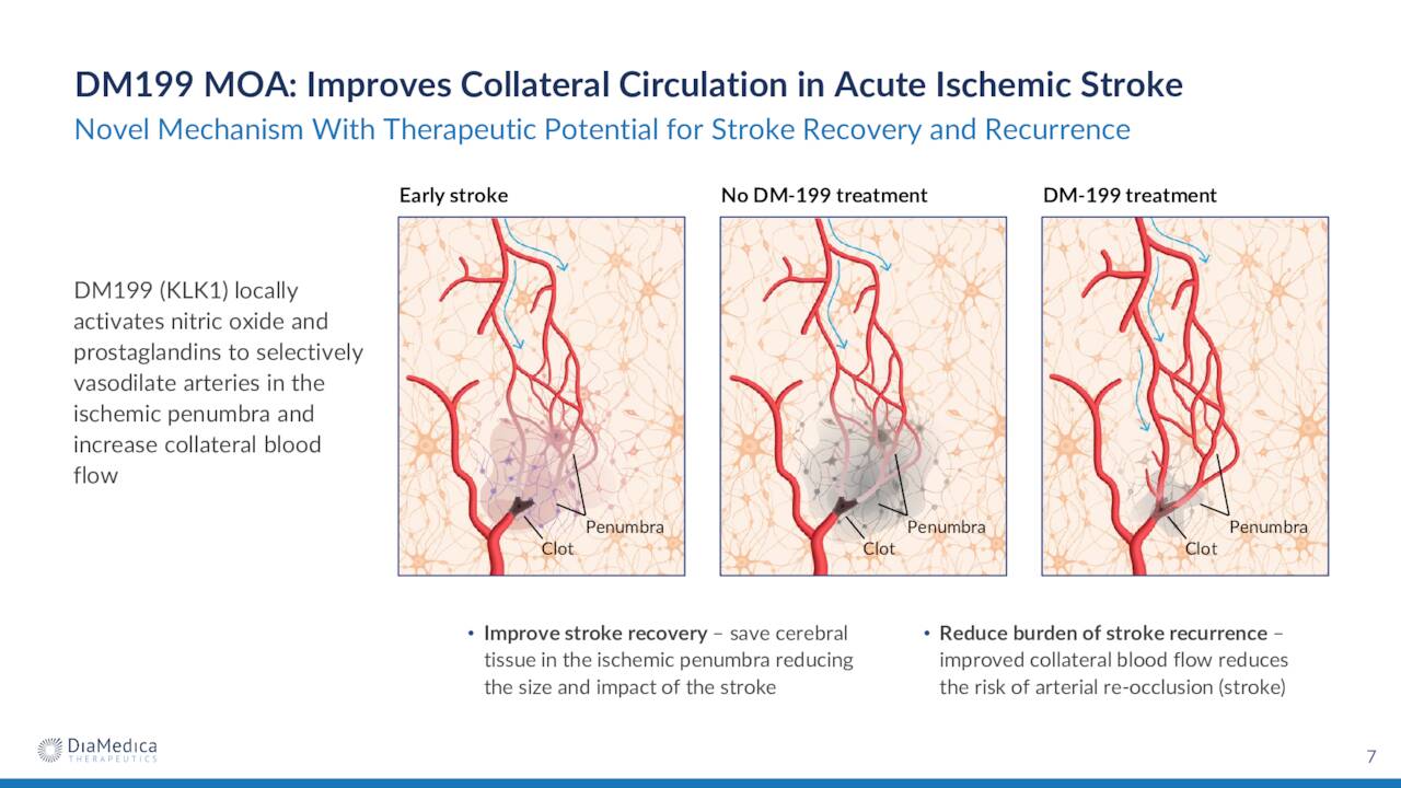 DM199 MOA: Improves Collateral Circulation in Acute Ischemic Stroke